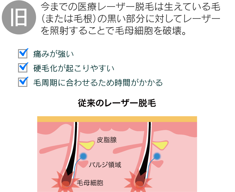 (旧)今までの医療レーザー脱毛は生えている毛（または毛根）の黒い部分に対してレーザーを照射することで毛母細胞を破壊。痛みが強い、硬毛化が起こりやすい、毛周期に合わせるため時間がかかる